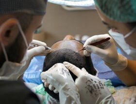 Tyrkiets hårtransplantationsindustri: Hvad du skal vide før du rejser