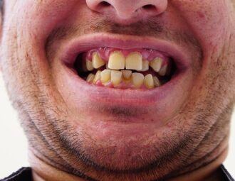 Sådan foregår en invisalign-behandling – trin for trin